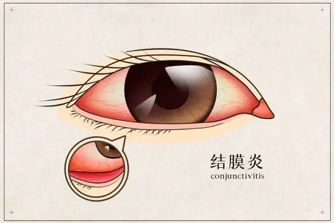 皮膚癢、拉肚子、腸胃不適、感冒，春夏換季病，艾灸來搞定！